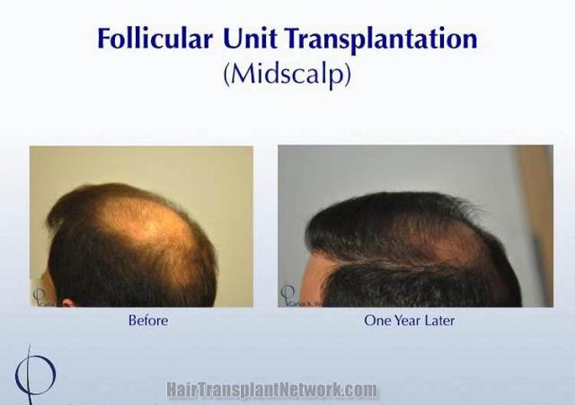 Hair restoration procedure before and after pictures