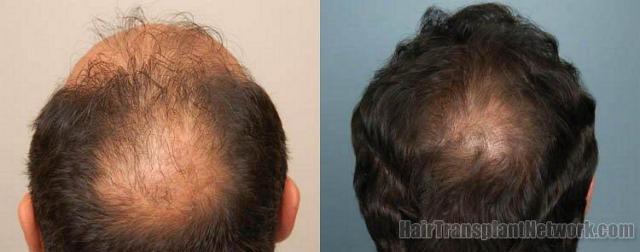 Back - Crown photos of before and after hair transplant