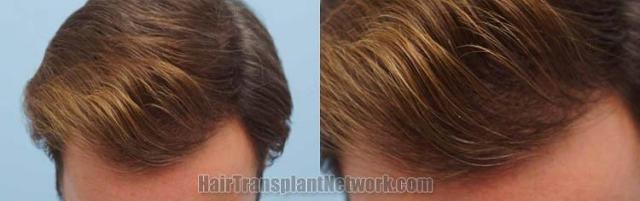 Hair transplantation surgery before and after pictures