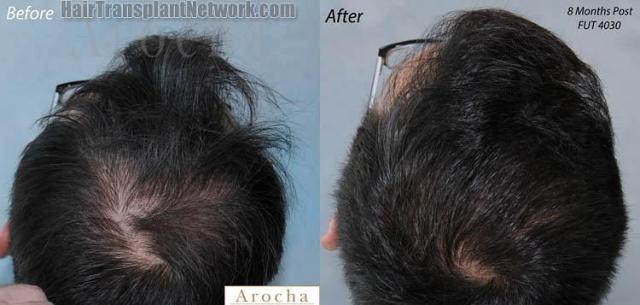 Hair transplantation surgery before and after pictures