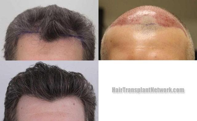 Hair restoration procedure before and after results