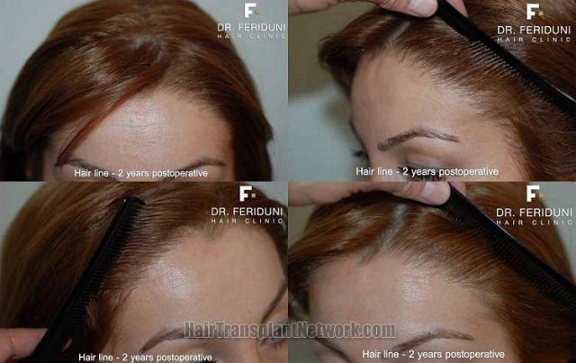 Hairline results from 1982 graft hair female hair restoration