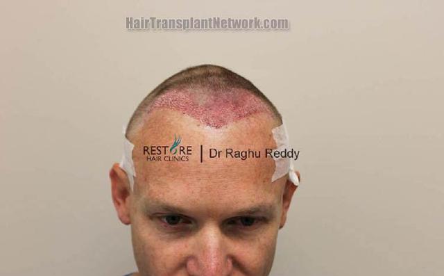 Hair transplantation surgery before and after photos