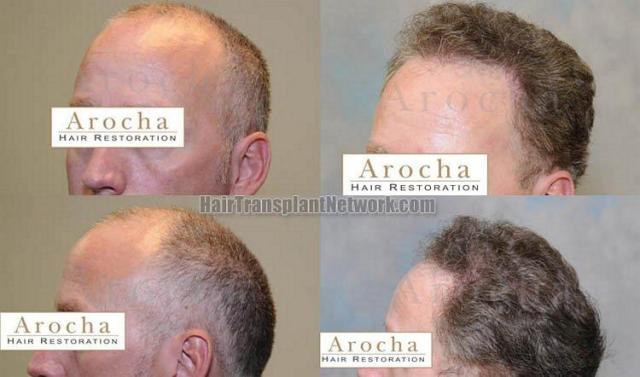 Left view - hair restoration before and after pictures