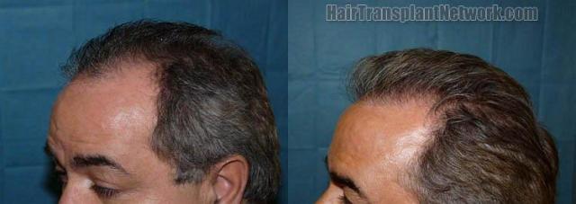 Left view before and after pictures from hair transplant procedure.