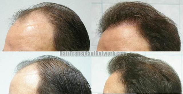 Hair restoration procedure results