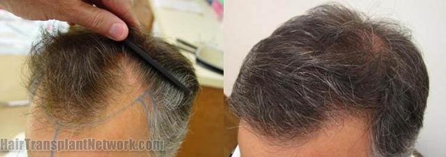 Before and after hair restoration procedure pictures