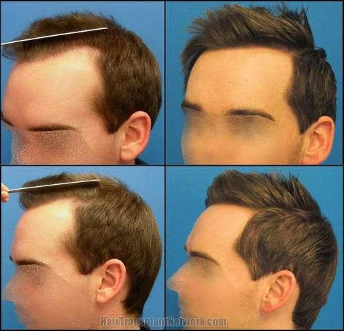 Hair restoration procedure before and after pictures