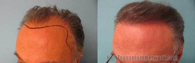 Hair restoration procedure before and after pictures