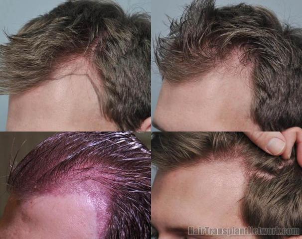 Hair transplantation surgery before and after pictures