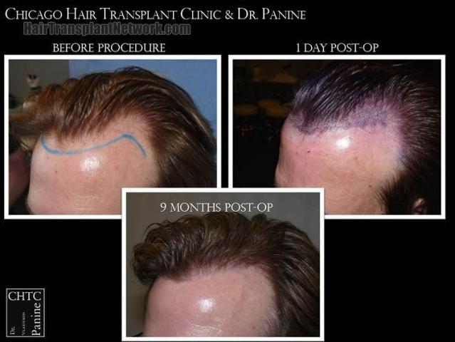 Hair transplantation surgery before and after images