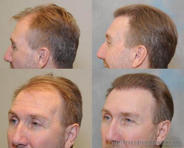 Left profile and oblique view hair transplant result pictures