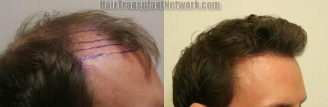 Right view before and after hair transplantation surgery