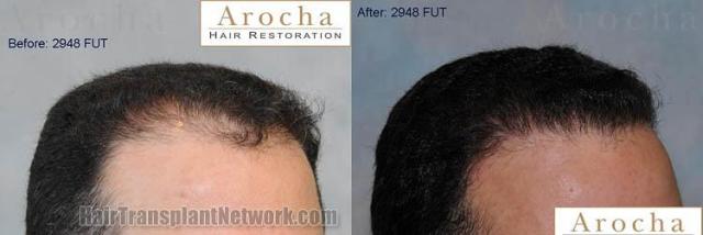 Before and after hair transplant procedure images