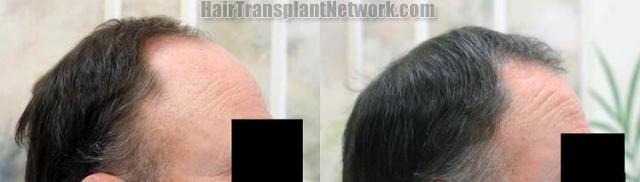 Hair transplantation surgery before and after images