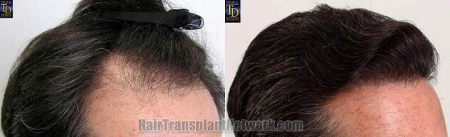 Hair transplantation surgery before and after images