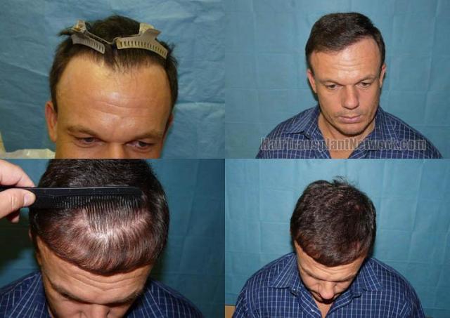 Top view before and after hair transplantation surgery