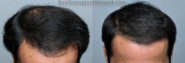 Top view before and after hair restoration results