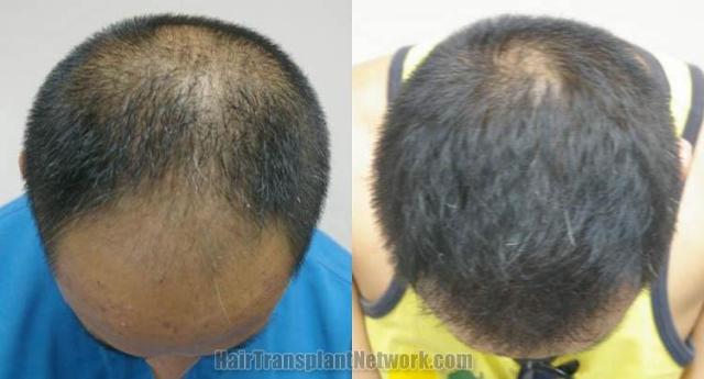 Top view before and after hair restoration results