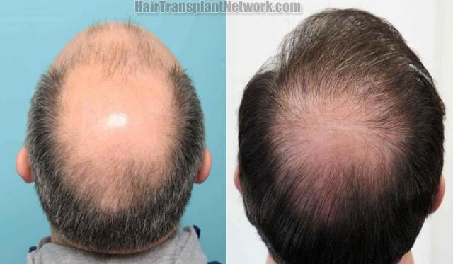 Back view before and after hair transplantation photos