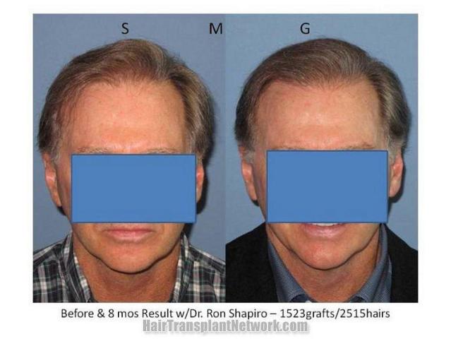 Hair transplant results - Front view before and after