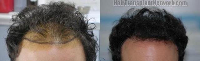 Hair restoration procedure before and after results