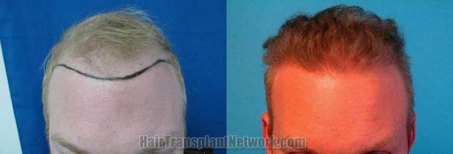 Before and after hair transplant procedure images