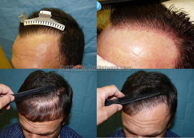 Before and after hair replacement surgery images