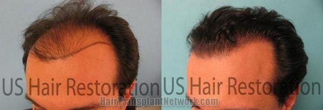 Left side views - hair replacement surgery photos