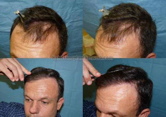 Hair restoration procedure result photos before and after