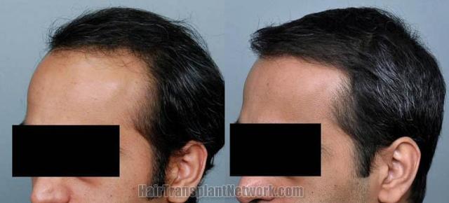 Hair transplantation surgery before and after images