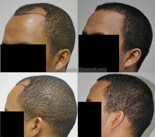 Hair transplantation surgery before and after images