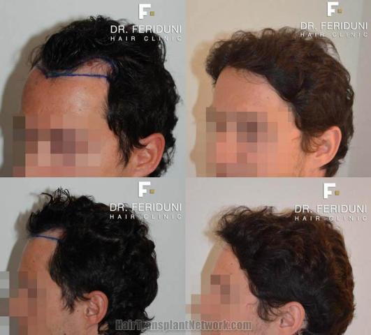 Hair transplantation surgery before and after photos