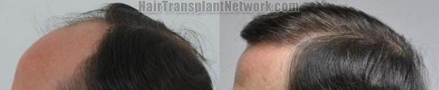 Hair transplantation surgery before and after photos