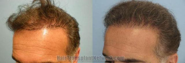 Hair restoration procedure before and after results