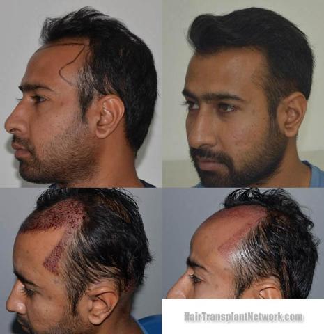 Hair transplantation surgery before and after images