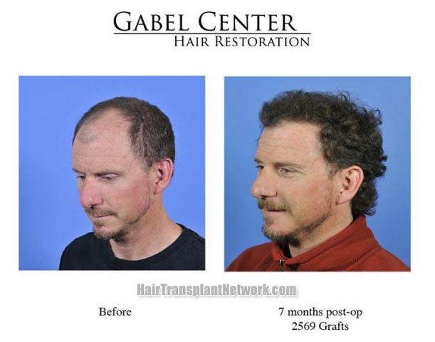 Left oblique view before and after hair transplant