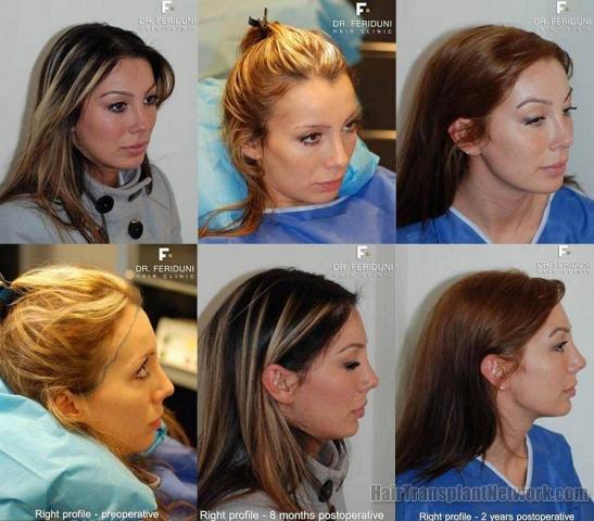 Right side photos of  female hair restoration results