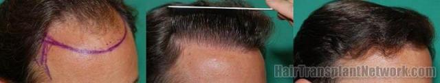 Right view before and 10 months after hair replacement