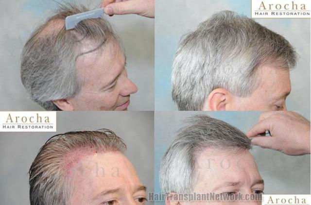 Right view before and after hair transplant procedure