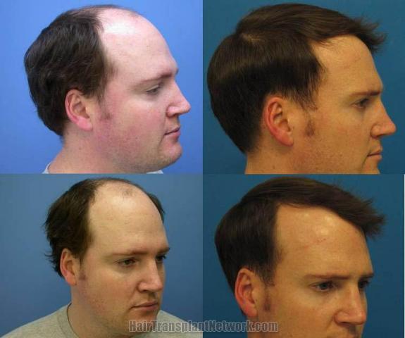 Right view - Before and after hair restoration