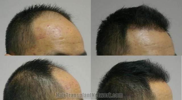 Hair restoration procedure before and after results