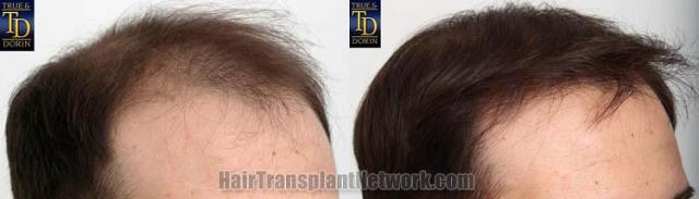 Hair transplantation surgery before and after images