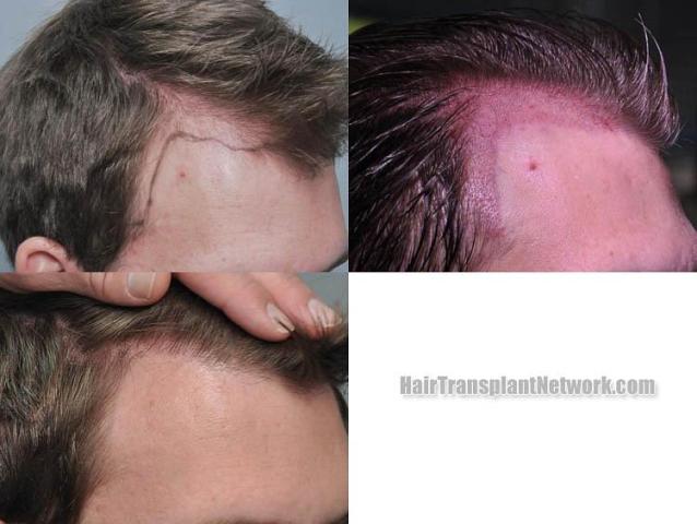 Hair transplantation surgery before and after images