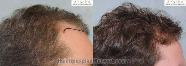 Hair restoration procedure before and after pictures