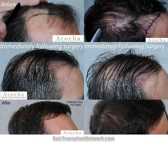 Hair transplantation surgery before and after photos