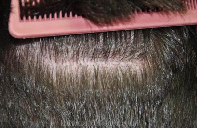 Hair restoration surgery before and after images