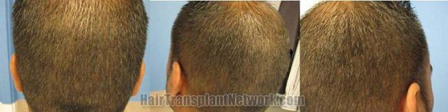 Donor area showing healed scar from hair transplant procedure