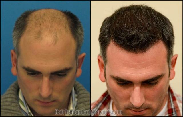 Hair transplantation surgery before and after photos