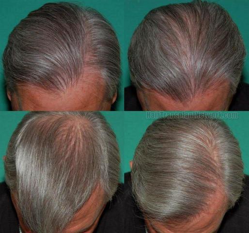 Hair restoration photos showing postoperative results